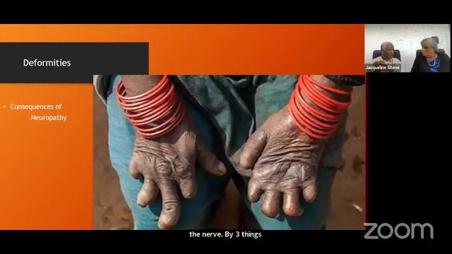 Multidrug Therapy (MDT)— A Revolutionary Approach смотреть онлайн