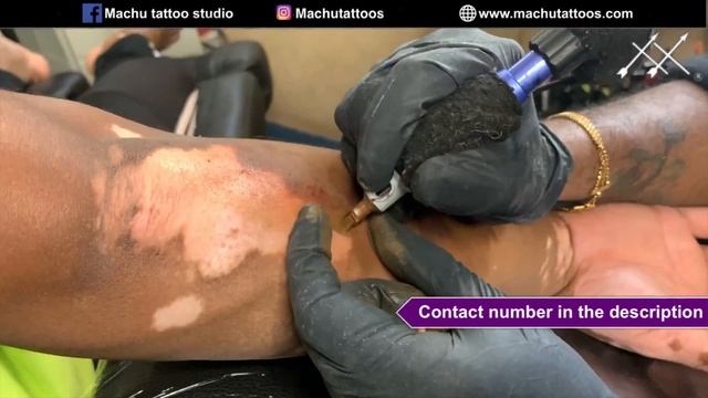 100% real skin tone from the latest vitiligo treatment Contact : +919659959593 смотреть онлайн
