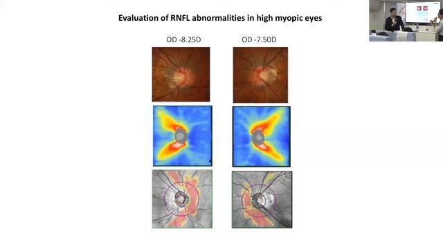 Primary Open Angle Glaucoma: Dr. Christopher Leung смотреть онлайн