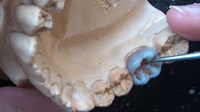 Dental Wax Up - Aufwachsübung Molar 36 [Waxup Tutorial]