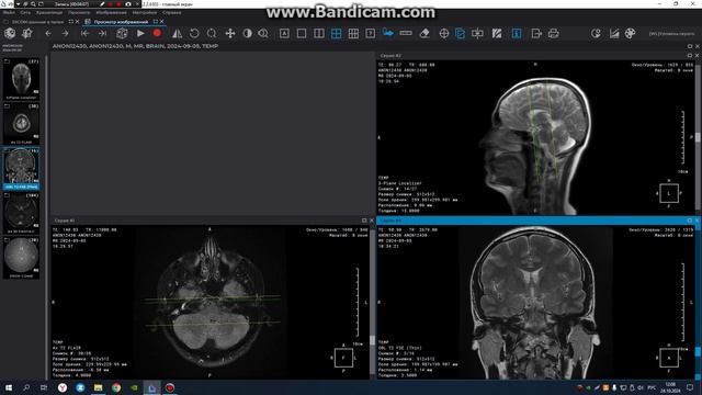 МРТ построение височных костей