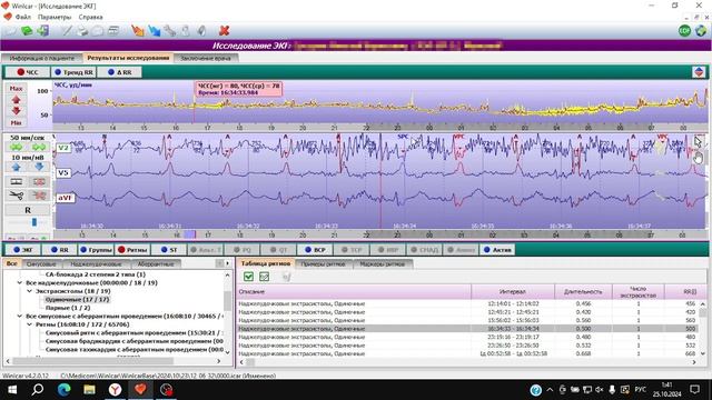 Пример обработки суточного мониторирования ЭКГ по холтеру в программе WinIcar. смотреть онлайн