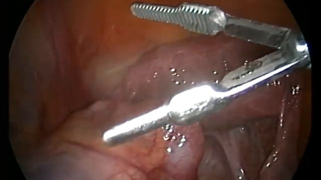 Shawki forceps Dolphin nose смотреть онлайн