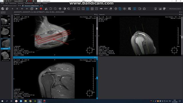 МРТ построение плечевого сустава