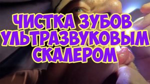 Скалер ультразвуковой для домашнего использования
