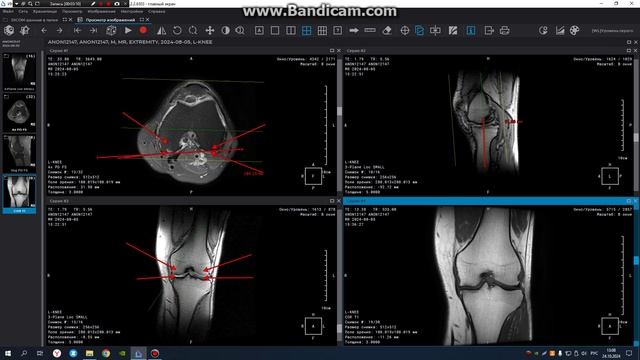 МРТ построение коленного сустава