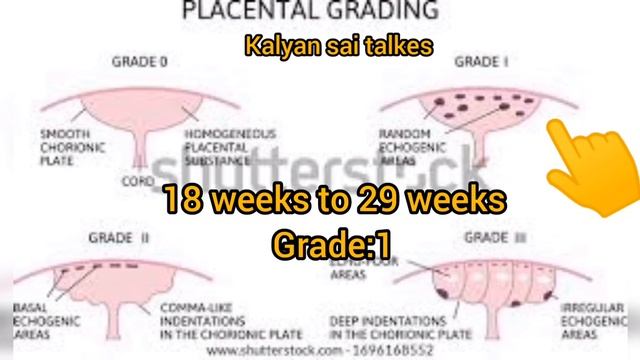 what is placenta grade in Telugu|| grade 0 to grade 3 || Kalyan sai talkes смотреть онлайн