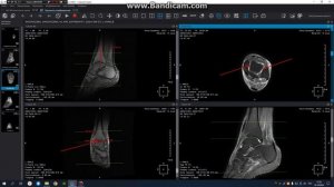 МРТ построение голеностопного сустава