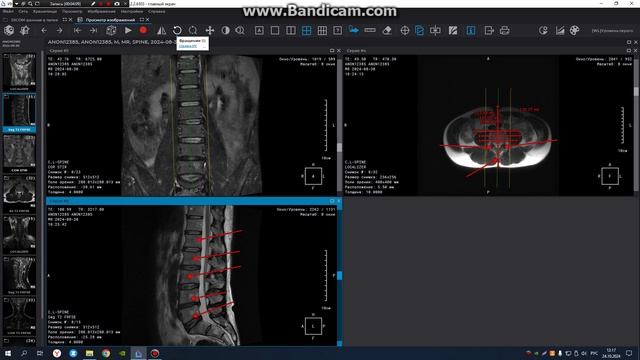 МРТ построение поясничного отдела