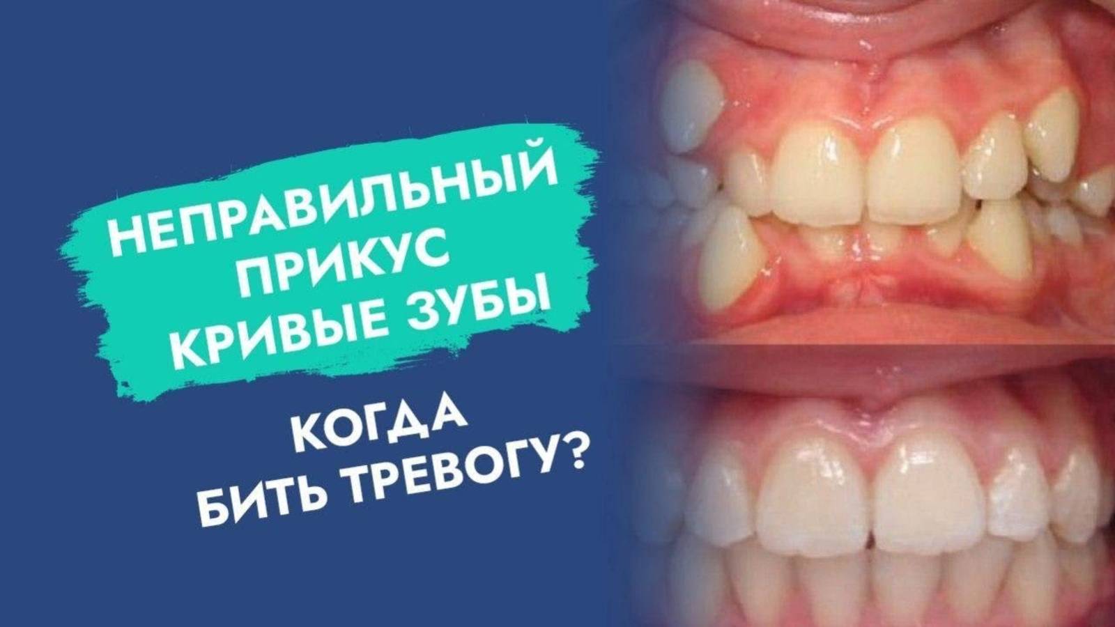 Самые серьезные проблемы с прикусом у детей и подростков!