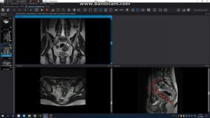 МРТ построение женского Малого Таза