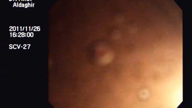 villous adenoma.wmv смотреть онлайн