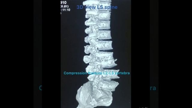 Spinal TB with post decompression, fusion and fixation смотреть онлайн
