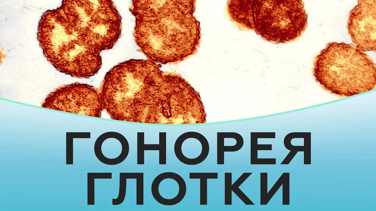 Гонорея горла. Диагностика гонореи горла. Лечение гонореи горла смотреть онлайн