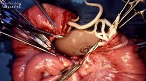 Паразиты  Глисты  Гельминты в организме человека.