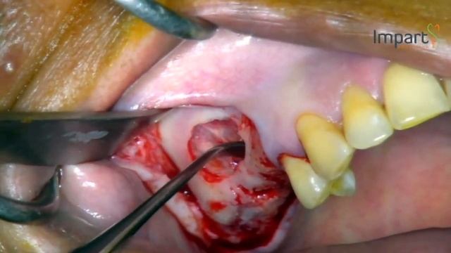 Direct sinus lift: Perforation management смотреть онлайн