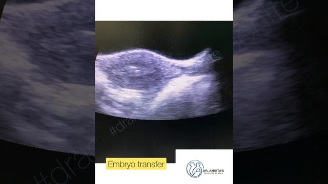 The journey from a single oocyte to a gestational sac! Dr.Ankita's Fertility Centre смотреть онлайн