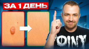 Как избавиться от папиллом и бородавок НАВСЕГДА