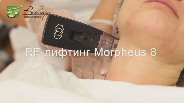 RF-лифтинг Morpheus 8 - косметологическая процедура подтяжки кожи на новейшем аппарате Inmode смотреть онлайн