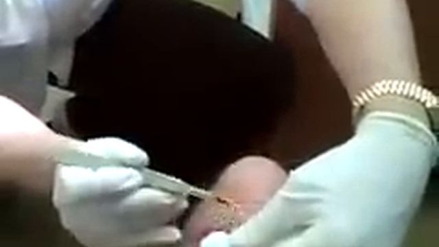 Keratoacanthoma, Begone! смотреть онлайн
