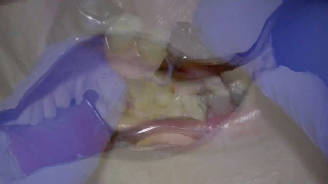 Fitting A Metal Based Chrome Cobalt Partial Denture