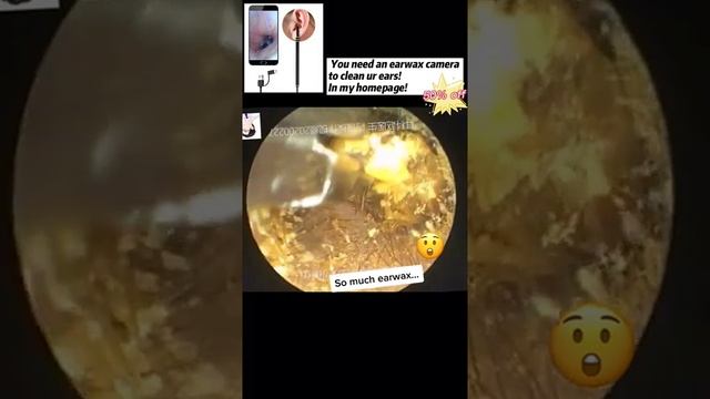 Best Ear Wax Removal & Extraction with Vacuum Remover 真空リムーバーによるにきびの除去と抽出 110 смотреть онлайн