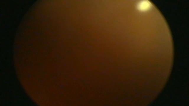 Трансуретральная биполярная энуклеорезекция аденомы простаты смотреть онлайн
