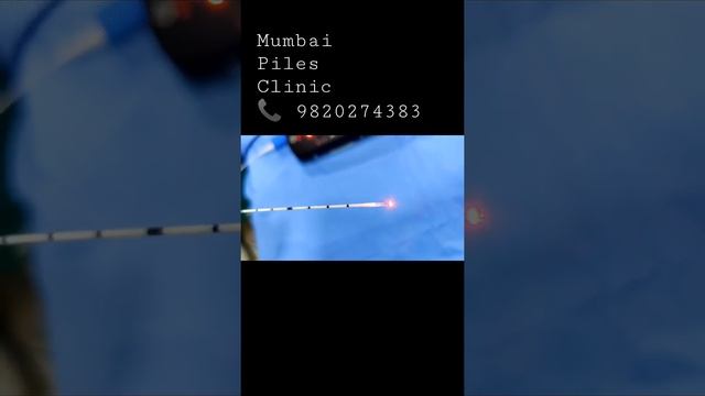 FiLAC laser fiber || Pilonidal sinus || Anal Fistula || Dr Sambit Patnaik смотреть онлайн