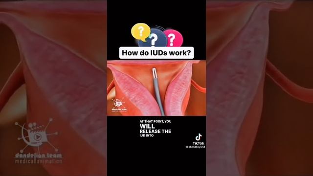 How IUD works | Birth control| Female health смотреть онлайн