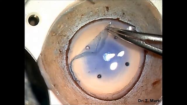 DMEK. Donor preparation.Technique and tricks смотреть онлайн