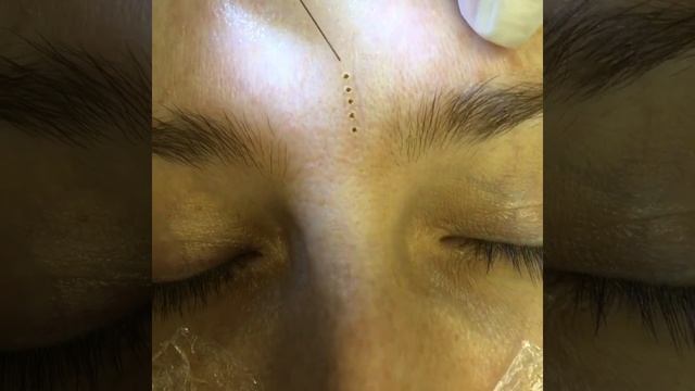 Plasma Pen Pro - Frown Line Removal Training using Plasma Pen Pro смотреть онлайн