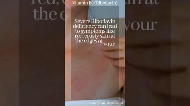 Symptoms Of Vitamin B2 Deficiency!
