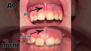 Пластика уздечки верхней губы.