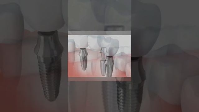 Импланты зубные смотреть онлайн