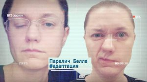 Паралич лицевого нерва (паралич Белла). Адаптация к жизни в новых условиях (2)