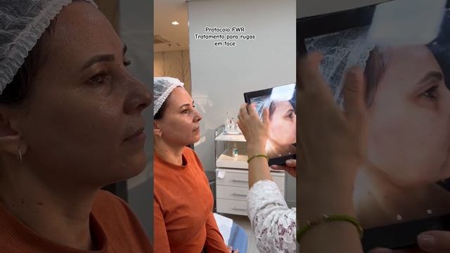 Protocolo FWR Tratamento para rugas em face Laser fotona SP Dynamis смотреть онлайн
