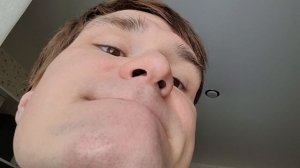 Лазерная шлифовка шрама ДО/ПОСЛЕ ч.2