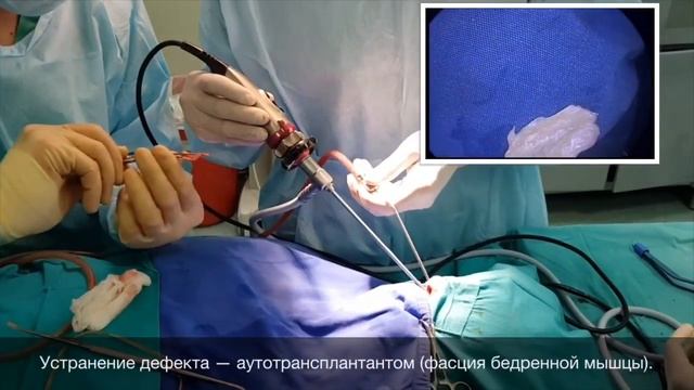 Эндоскопическое устранение дефекта черепа смотреть онлайн