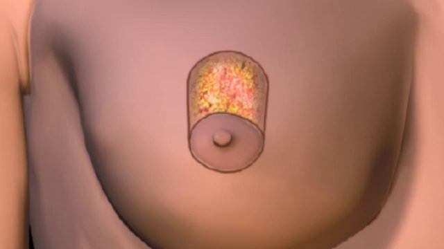 How Breast Lift Works Animation - Breast Reduction Procedure Video смотреть онлайн