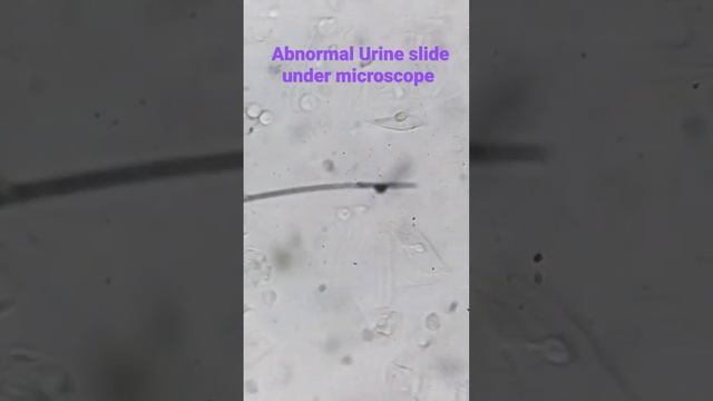 Abnormal urine slide under microscope || Epithelial Cell , pus cell ,RBC || Pathology смотреть онлайн