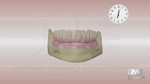 DME Zir-Lock - Removible prosthesis, fix implant. смотреть онлайн