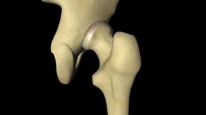 Эндопротезирование тазобедренного сустава