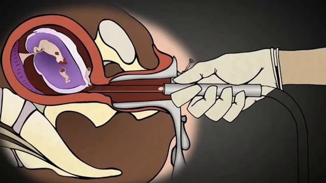 Vacuum Aspiration: for Abortion 😱😢🥺 смотреть онлайн