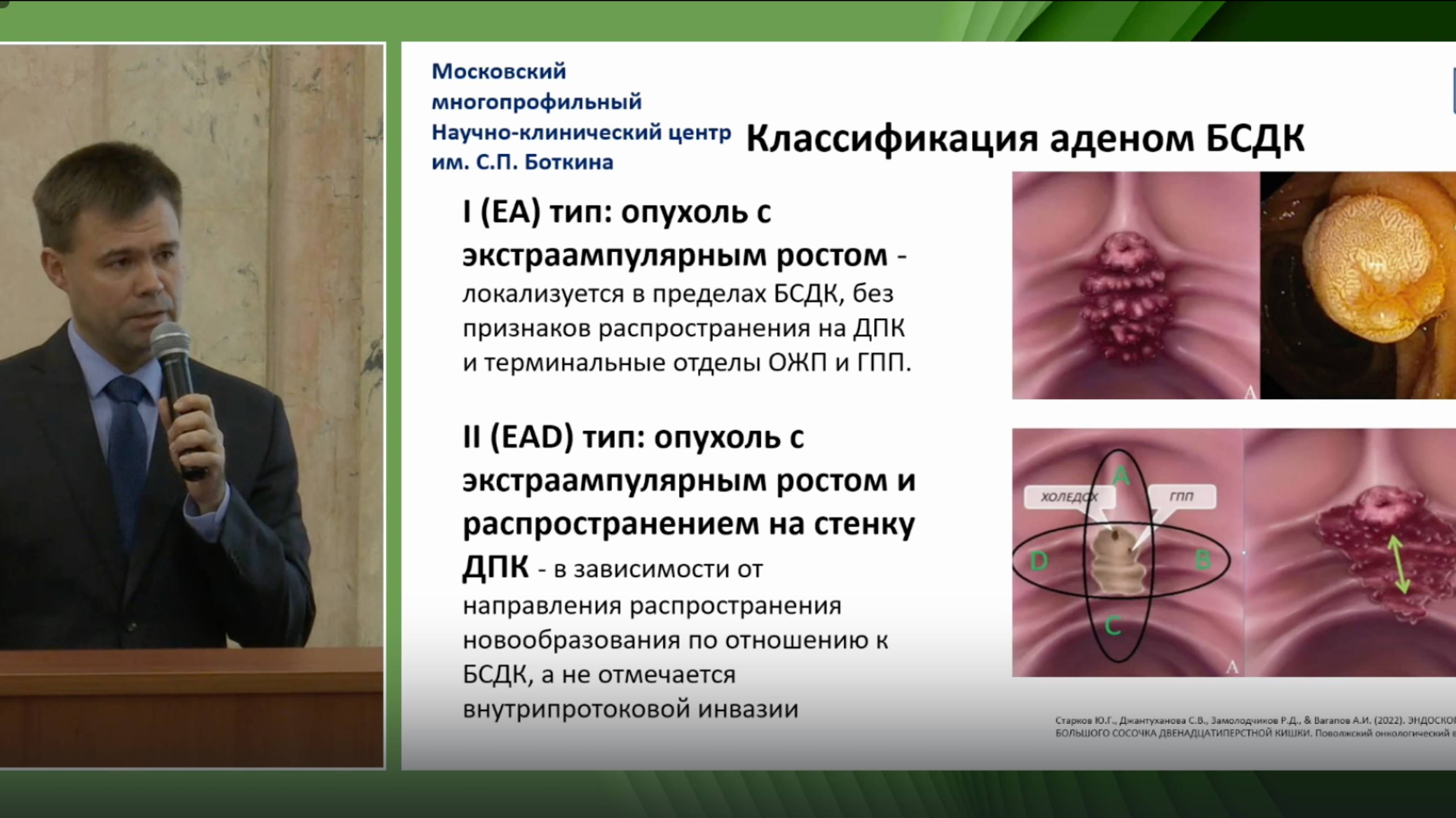 1. Балахольцев А.А. Папиллэктомия и резекция гигантской LST-опухоли ДПК. Клинический случай.