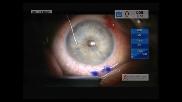 XEN GEL STENT - НОВ АНТИГЛАУКОМЕН ИМПЛАНТ смотреть онлайн