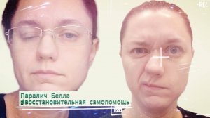 Паралич лицевого нерва (парез лицевого нерва, паралич Белла). Восстановительная самопомощь (3)