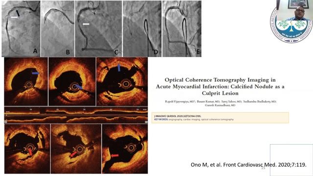 Image guided PCI : What is new in 2020? смотреть онлайн