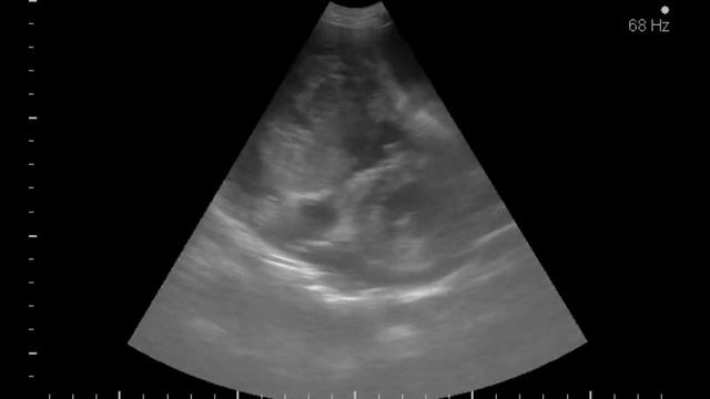 гемангиосаркома сердце смотреть онлайн