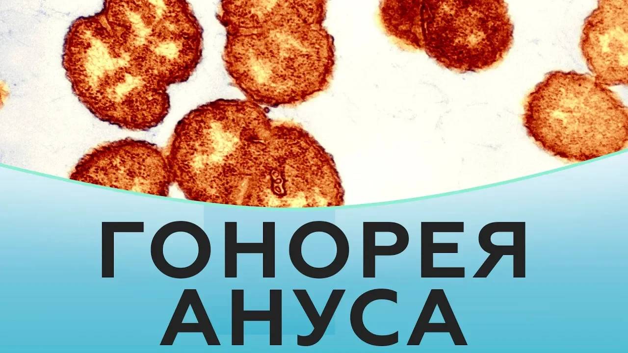 Гонорея ануса. Как лечить гонорею ануса. Лечение гонореи ануса смотреть онлайн