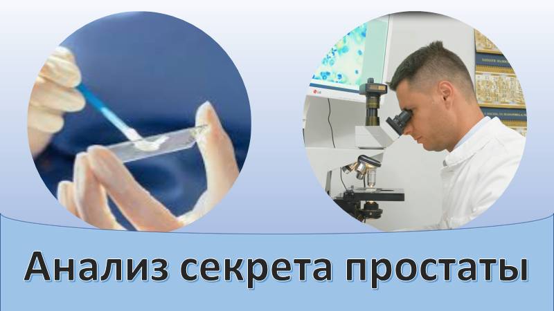 Анализ секрета простаты смотреть онлайн